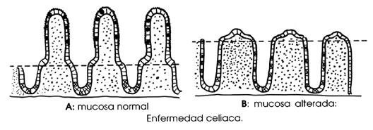 Esquema de Enfermedad Celíaca - <div style=